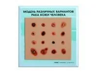 310_Модель_вариантов_рака_кожи