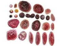 М0220 Комплект накладных моделей заболеваний и повреждений кожных покровов человека КР-Н 1.01