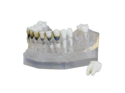 М0319 Денто-модель верхней и нижней челюстей для лечения пародонтоза ЧВН-28П