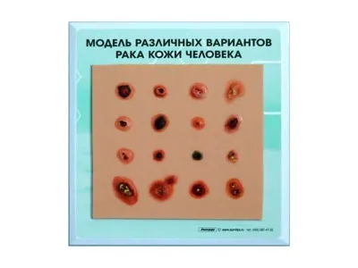 М0121 Модель различных вариантов рака кожи человека