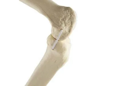 1019622 Колено, стандартное, левое, ORTHOBone