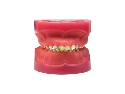 М0253 Денто-модель с патологиями ЧВН-24П