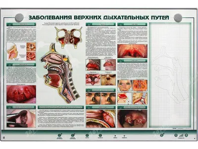 310_Заболевания_верхних_дыхательных_путей