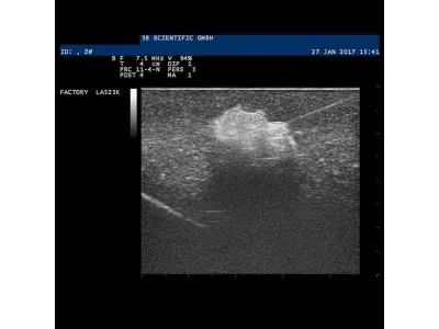 1019635 Модель молочной железы с опухолями SONOtrain™ с возможностью УЗИ-обследования