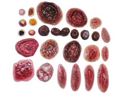 М0220 Комплект накладных моделей заболеваний и повреждений кожных покровов человека КР-Н 1.01