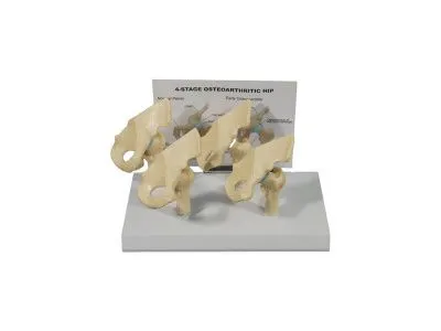 ZM2092 Модель патологий тазобедренного сустава