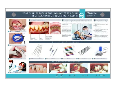 310_МУ0212_Стенд_Удаление_поддесневых_зубных_отложений