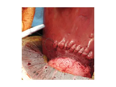 1022567 Тренажер навыков неотложного кесарева сечения C-Celia