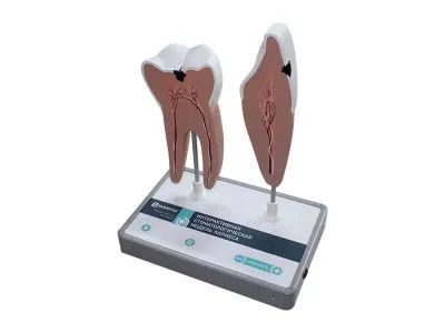 М0041 Интерактивная стоматологическая модель кариеса