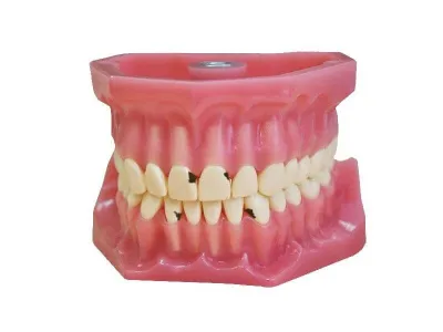 М0360 Денто-модель верхней и нижней челюстей для лечения кариеса ЧВН-32К