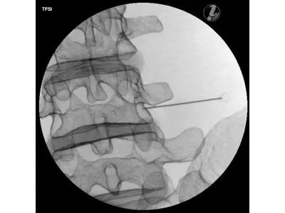1021898 Тренажер для спинальных инъекций с визуальным контролем