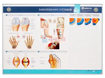 310_МУ0073_Стенд_Заболевания_суставов