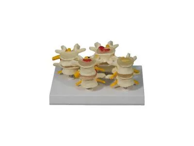 ZM2077 Модель патологий позвонков (на подставке)