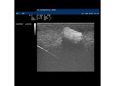 1019635 Модель молочной железы с опухолями SONOtrain™ с возможностью УЗИ-обследования