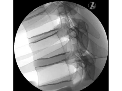 1021899 Тренажер для спинальных инъекций в грудную клетку под визуальным контролем