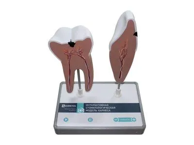 М0041 Интерактивная стоматологическая модель кариеса